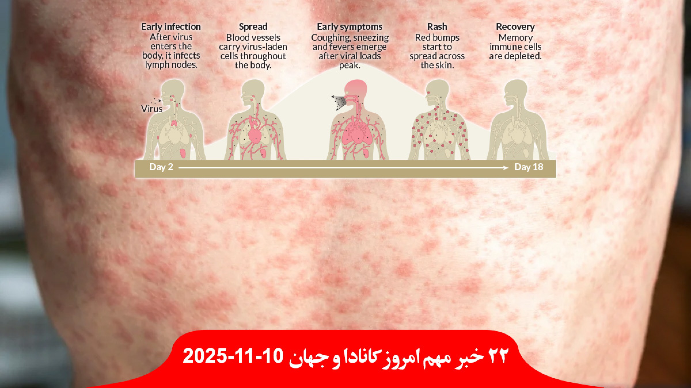 کانادا-تنها-کشور-بدون-سرخک-آلوده-ترامپ-بی-بی-سی-سو-حامیان-عفو-اسرائیل-پیش-پایان-حکومت-ایران-سرنگون