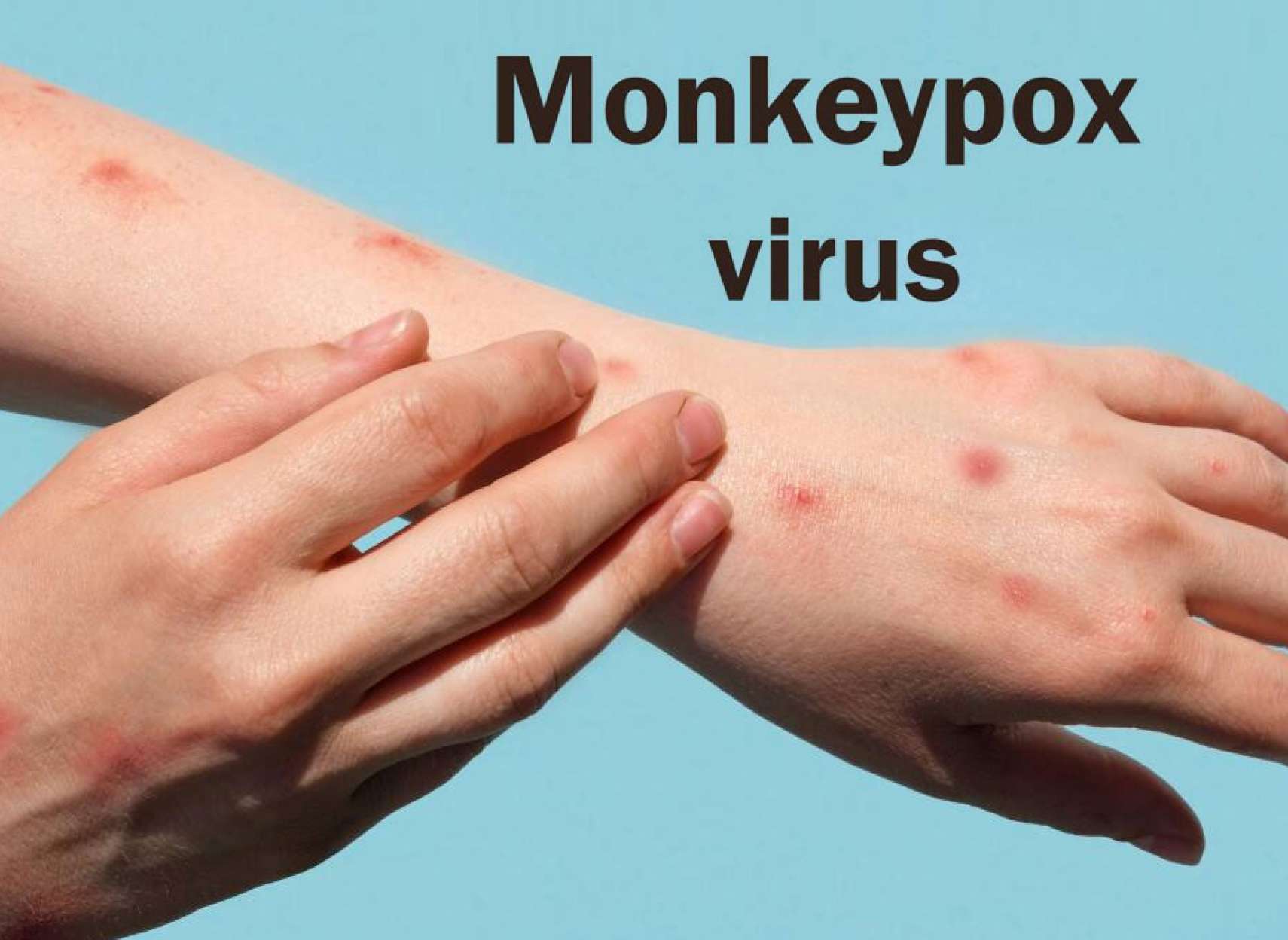 خبر-کانادا-ادامه-آمار-عجیب-آبله-میمونی-۸۹۰-مورد-انتاریو-از-کبک-پیشی-گرفت