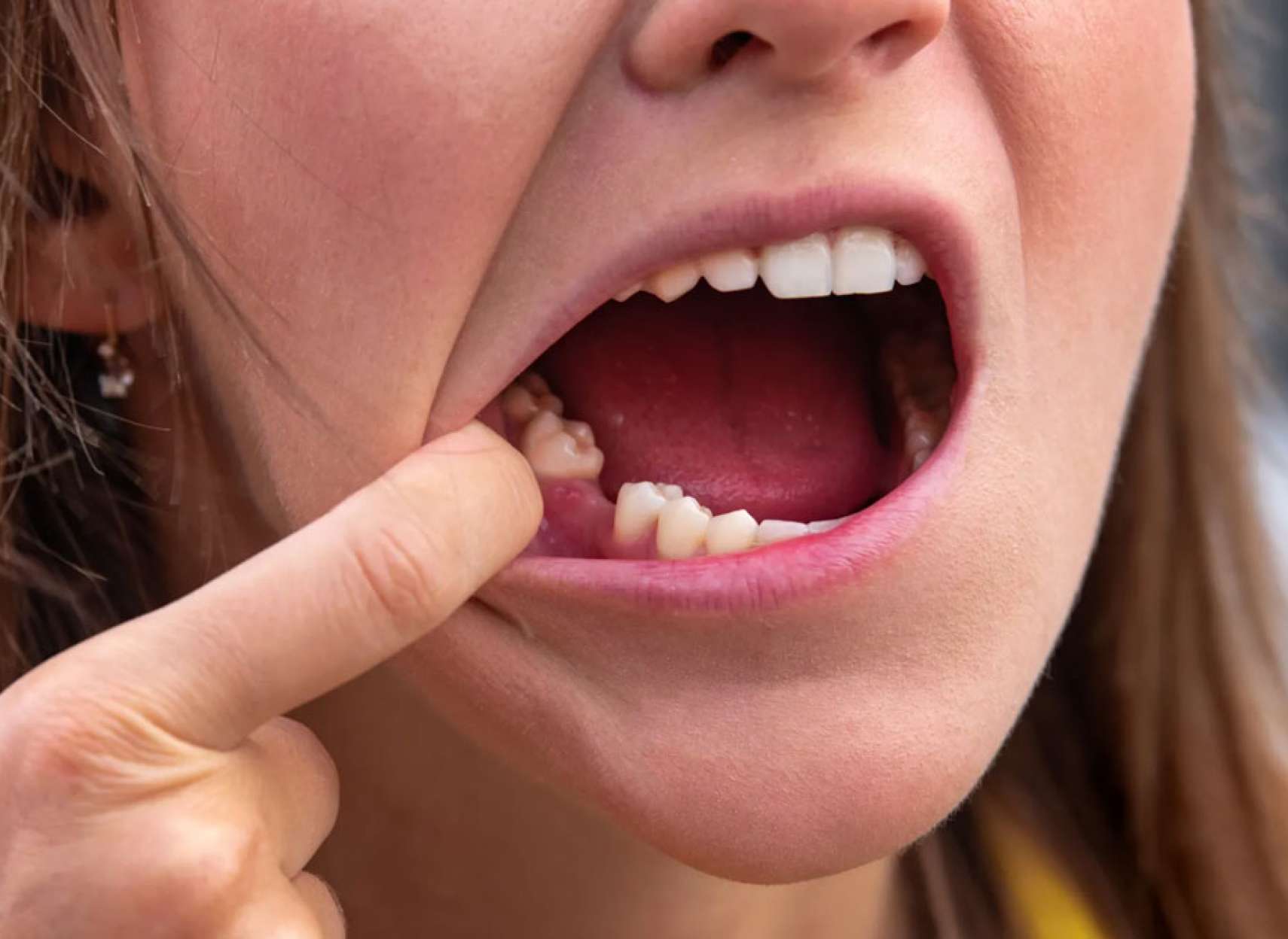 علمی-خداحافظ-دندانپزشک-اولین-داروی-جهان-رشد-مجدد-دندان-آزمایش-بالینی